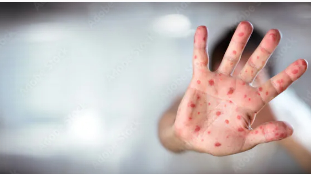 Sarampión: las consecuencias y los riesgos del virus en un niño no vacunado