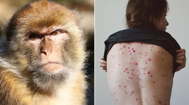 Viruela del mono: qué es la rara enfermedad que preocupa a Europa y EEUU