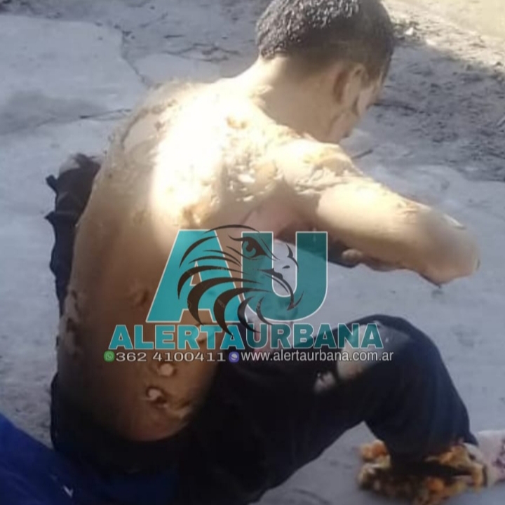 Imágenes tremendas-Resistencia: le explotó una garrafa y tiene el 100% del cuerpo quemado 
