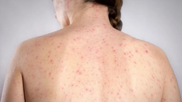  Alerta por brotes de sarampión y llamado a vacunar a niños