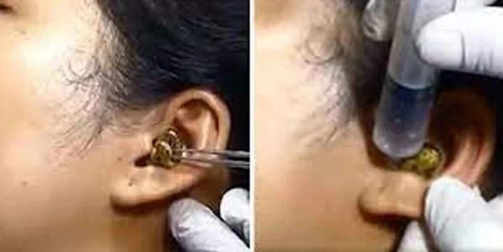 Estremecedor: un cirujano sacó una serpiente de la oreja de una paciente