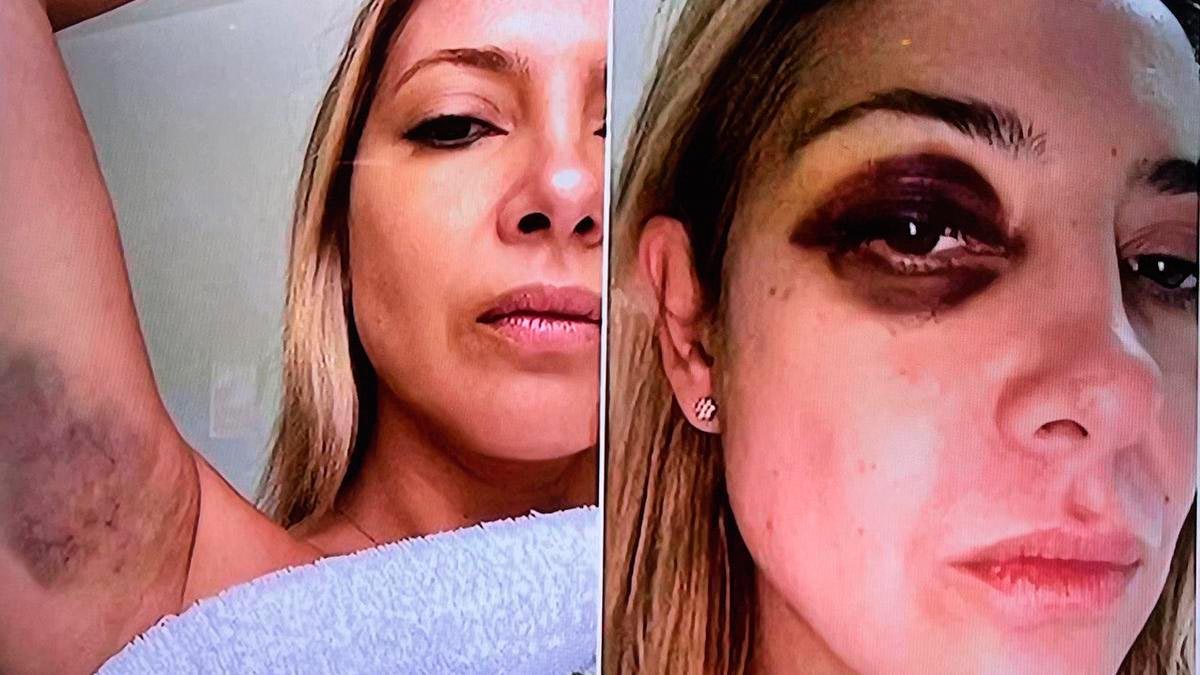 Confirman que Fabiola recibió un desinflamatorio en la fecha que denunció los golpes de Alberto