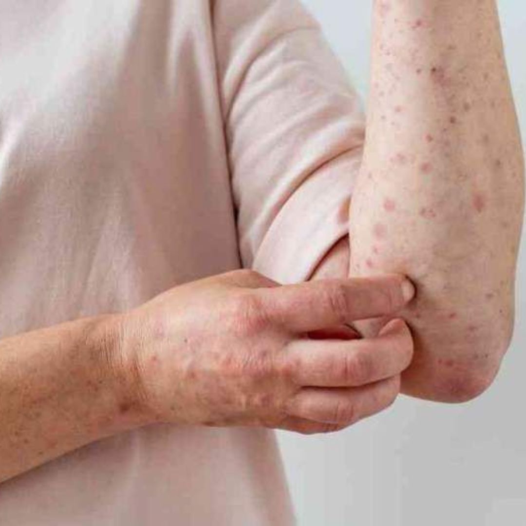 Viruela del mono: ya hay 22 casos confirmados en Argentina 