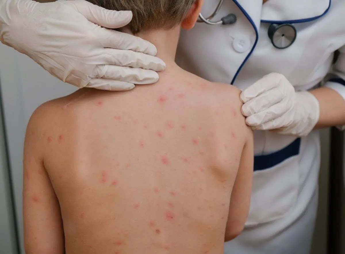 Epidemia de sarampión en Paraguay: detectan más de 40 casos 