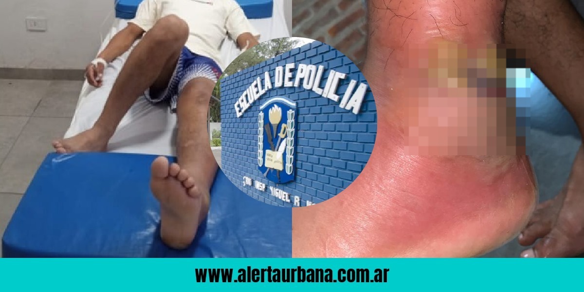 “Se le pudrió el tobillo y tenía gusanos”: Cadete se esguinzó en la Escuela de Policía, se complicó su salud y ahora le piden la baja